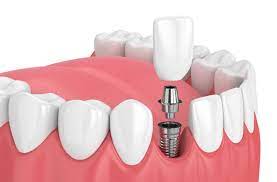 dental implant example Redwood City, CA